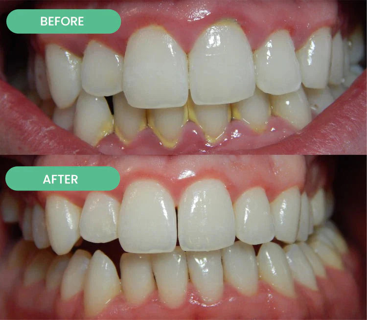 Friesto™ Ultraschall Zahnreinigungsstab